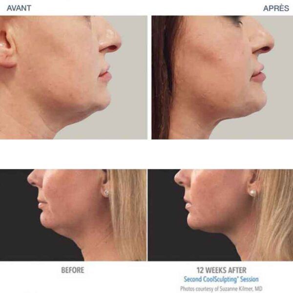 Masseur Lifteur Visage et Cou – Image 5